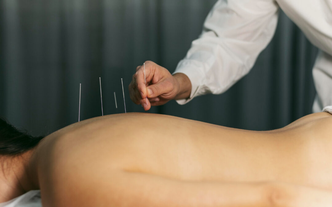 Exploring the Role of Acupuncture in Promoting Wellness