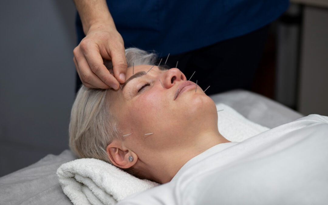 Exploring the Wonders of Facial Acupuncture: Everything You Need to Know