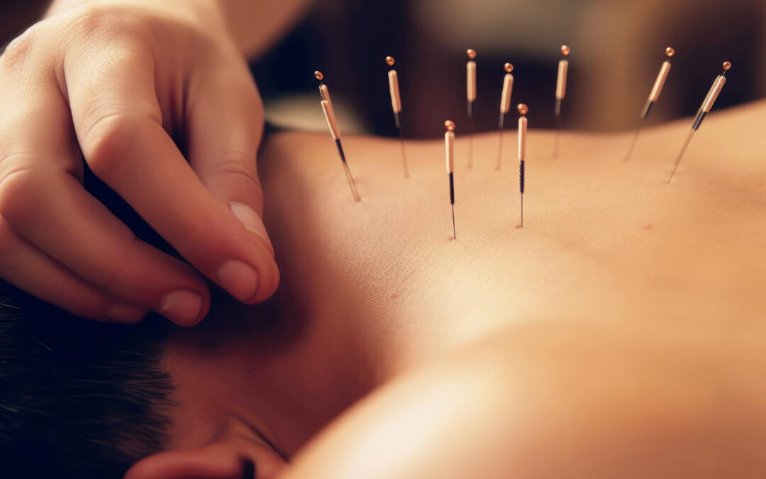 Who Can Benefit from Acupuncture?